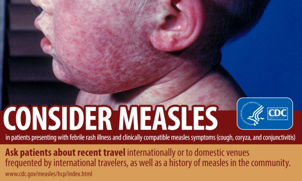 Measles Advisory