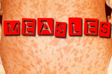 MEASLES UPDATE!